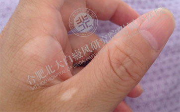 北大巅峰时期_白巅峰是否能完全治好询北大m_北大白颠疯医院位置