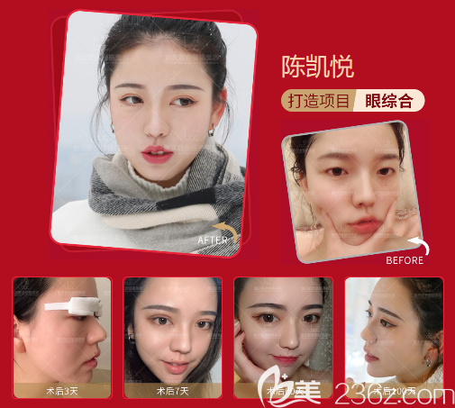 三点定位双眼皮术后-三点定位双眼皮术：从忐忑到自信，我的美丽蜕变之旅