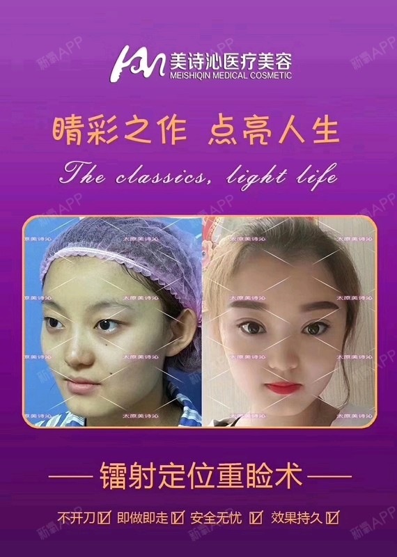 双眼术皮定位点后多久能好_六点定位双眼皮术后_双眼皮定位后怎么护理