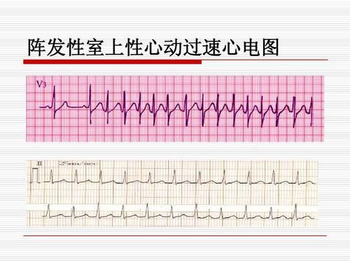 阵发性室上性心动过扑_心室扑动室性心动过速_阵发心房扑动