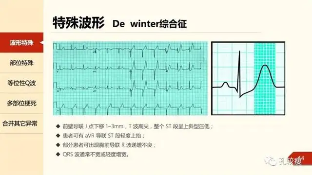 心电图异常q波下壁心肌梗塞_心电图q波异常能恢复吗_异常q波