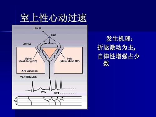 阵发性室上性心动过速的治疗_阵发性房性心动_阵发性房动心动过速